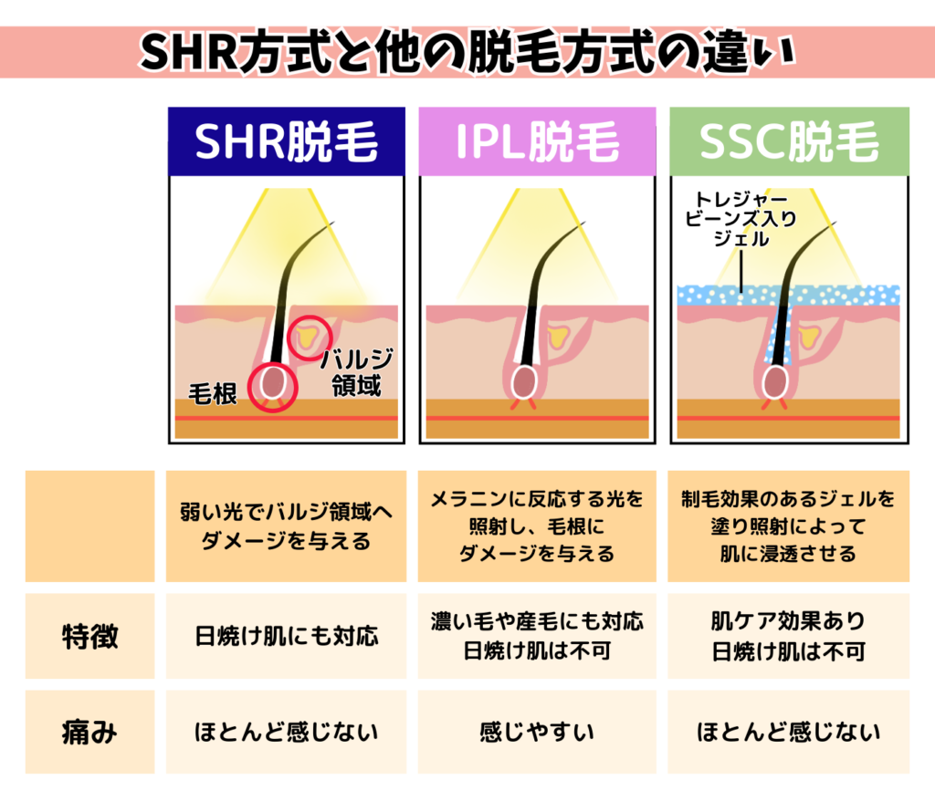 SHR方式と他の脱毛方式の違い