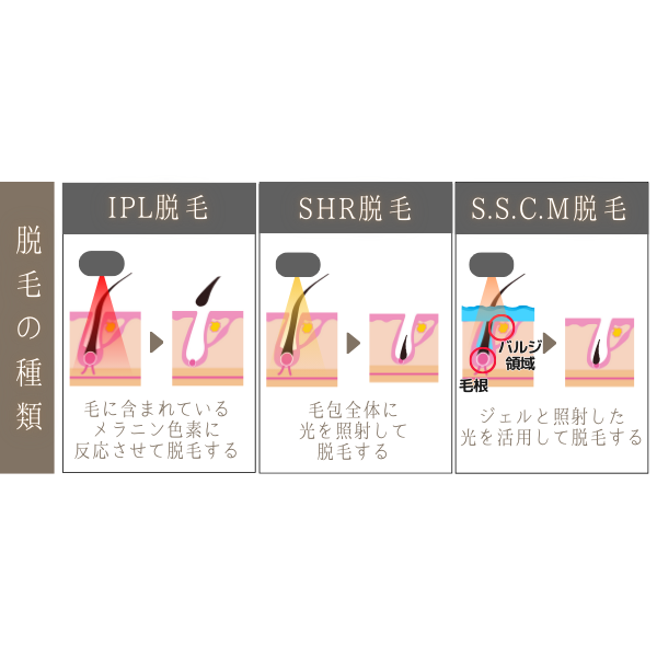 脱毛の施術方式とそれぞれの効果